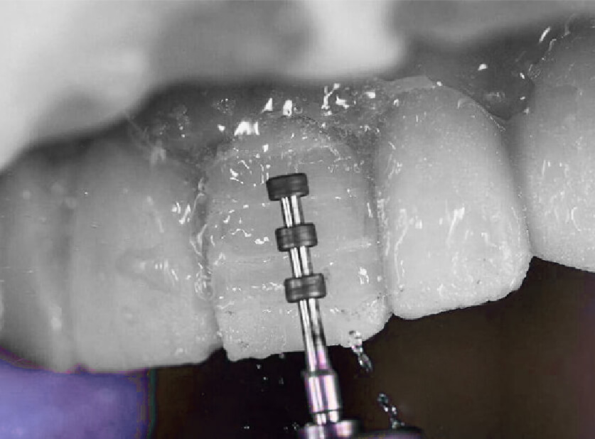 Dentalvip - ¿Es necesario tallar los dientes?