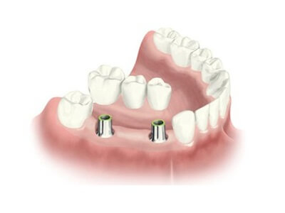 Prosthesis Image